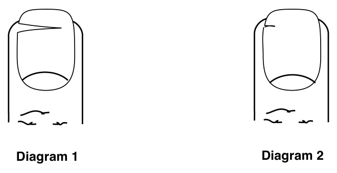 Diagram 1: a fingernail torn across more than half its width. Diagram 2: a fingernail torn across less than half its width.